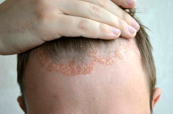 La Dermatite Séborrhéique Est-elle Une Cause De Perte De Cheveux ?
